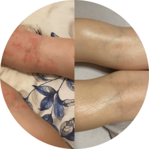 sheaõli aroopiline dermatiit